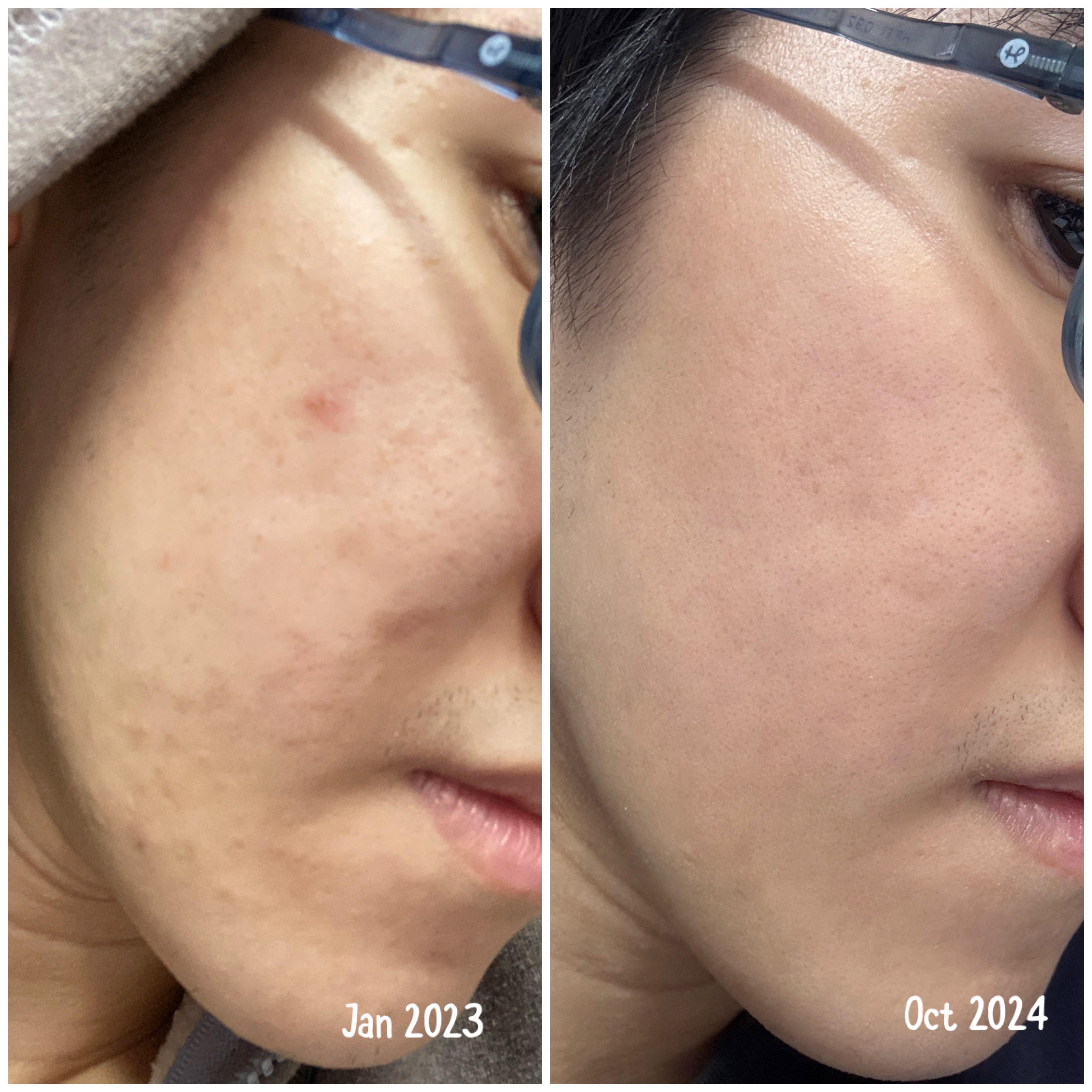 Before and After Results